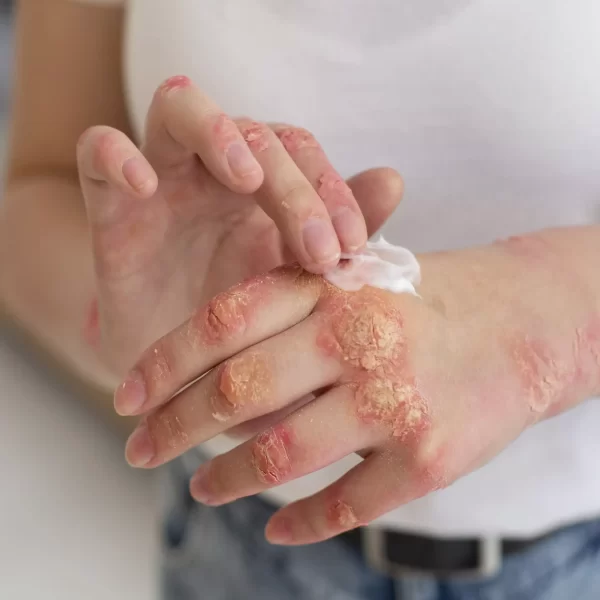 Traitement du psoriasis