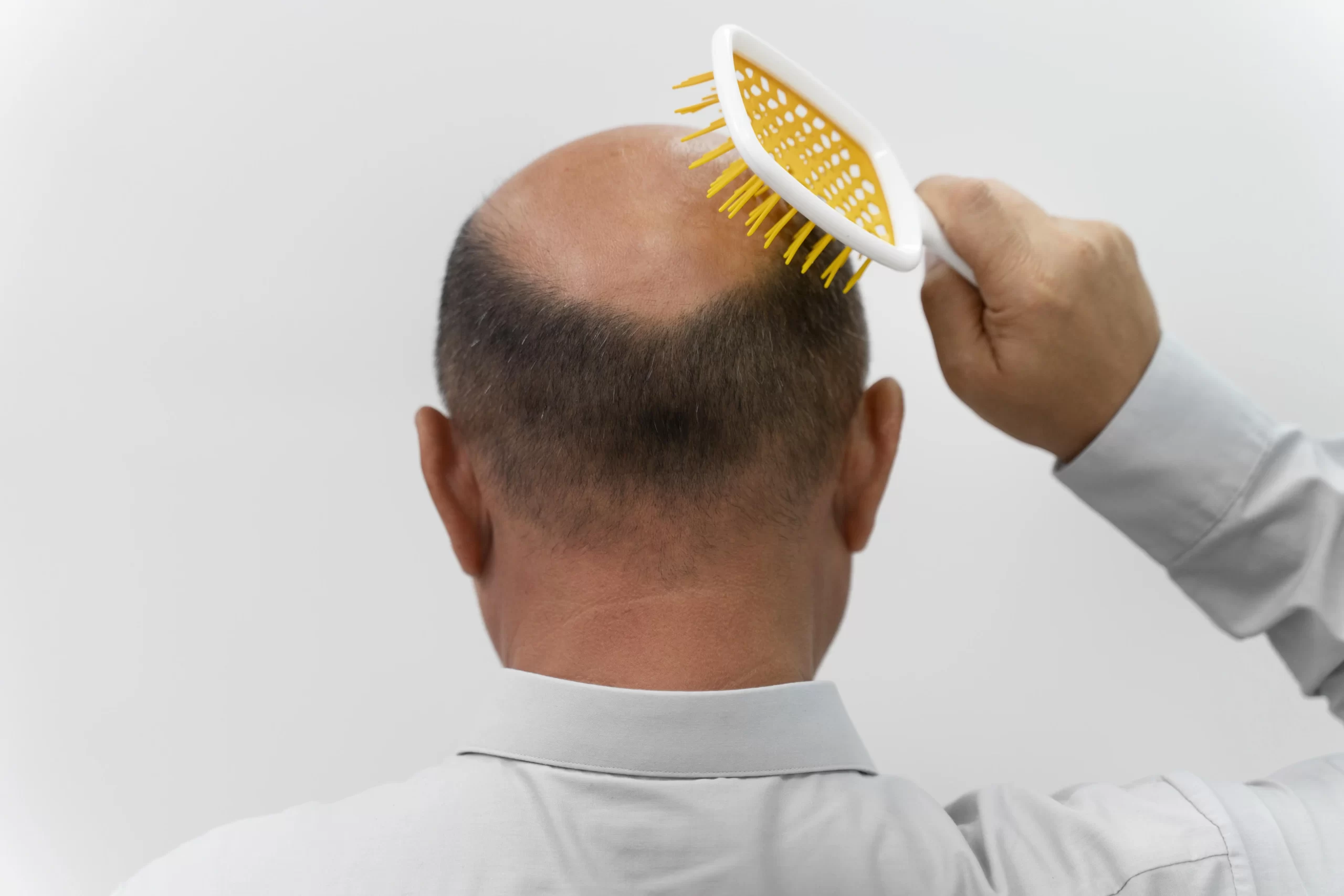 The Truth About Testosterone and Hair Loss