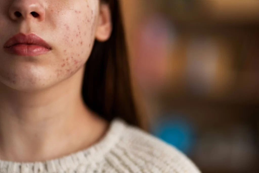 How to Get Rid of Acne Scars, Post-Inflammatory Hyperpigmentation, and Red Marks